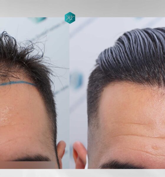 Hair Loss Treatment Hair Follicle Cloning