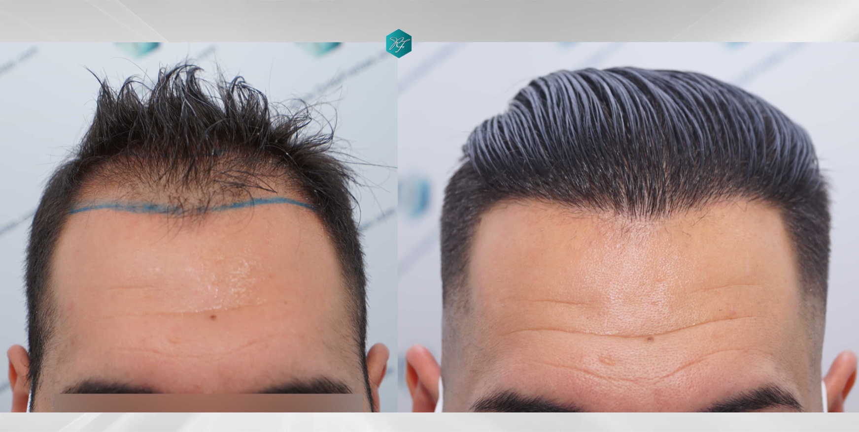 Hair Loss Treatment Hair Follicle Cloning